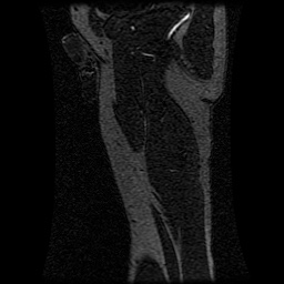 Alveolar soft part sarcoma (Radiopaedia 64501-73678 D 29).jpg