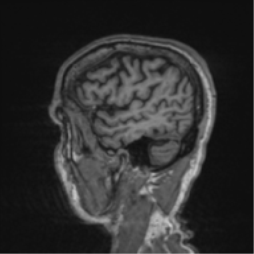 File:Alzheimer's disease- with apraxia (Radiopaedia 54763-61011 Sagittal T1 59).png