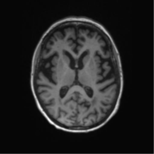 File:Alzheimer's disease (Radiopaedia 42658-45802 Axial T1 76).png