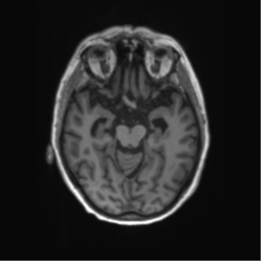 File:Alzheimer's disease (Radiopaedia 42658-45802 Axial T1 96).png
