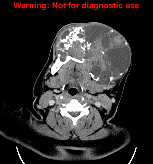 File:Ameloblastoma (Radiopaedia 33126-34164 B 16).jpg