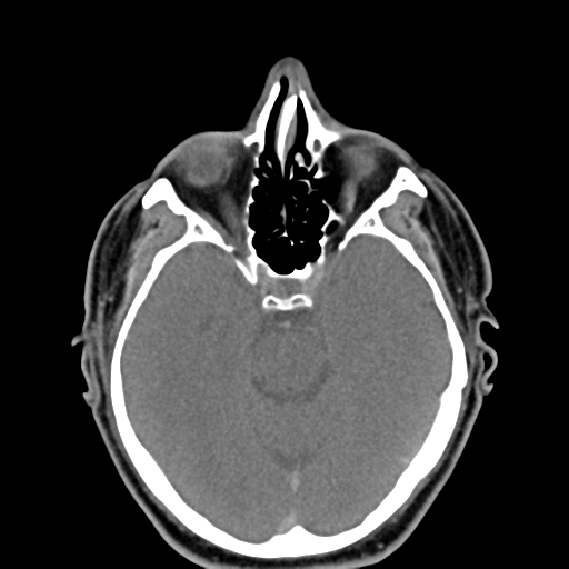 Ameloblastoma (Radiopaedia 38520-40623 Axial non-contrast 6).png