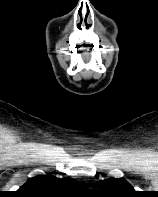 Ameloblastoma (Radiopaedia 38520-40623 Coronal non-contrast 17).png