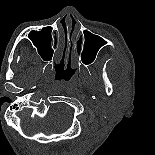 Ameloblastoma (Radiopaedia 51921-57766 Axial bone window 131).jpg