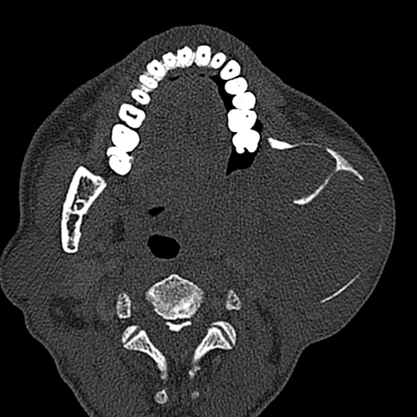 Ameloblastoma (Radiopaedia 51921-57766 Axial bone window 83).jpg