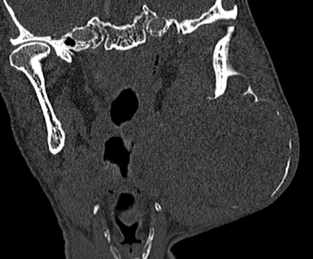 Ameloblastoma (Radiopaedia 51921-57766 Coronal bone window 172).jpg