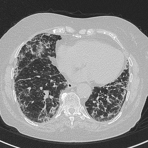 File:Amiodarone-induced pulmonary fibrosis (Radiopaedia 82355-96460 Axial lung window 48).jpg