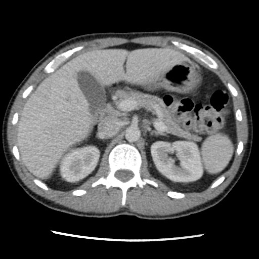 Amoebic liver abscesses (Radiopaedia 55536-62009 A 32).jpg