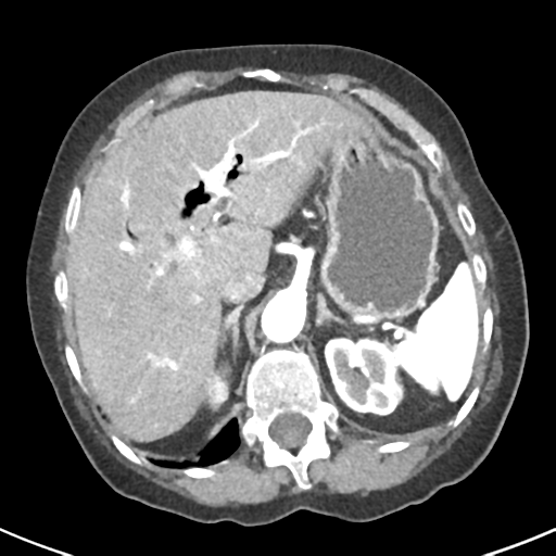 Ampullary adenocarcinoma (Radiopaedia 34013-35237 B 18).png