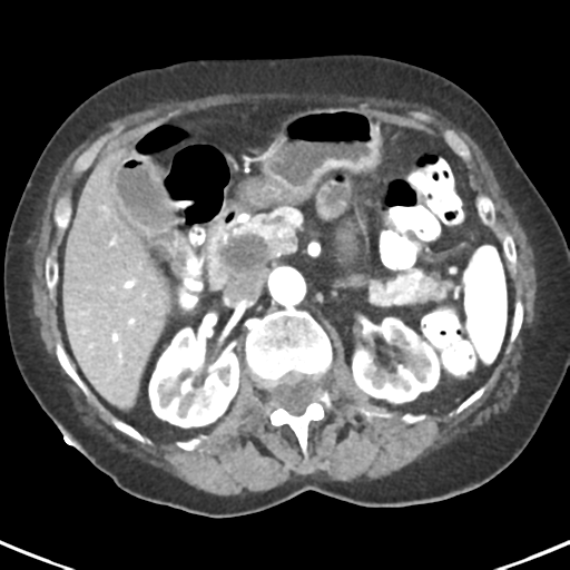 Ampullary adenocarcinoma (Radiopaedia 34013-35237 B 33).png