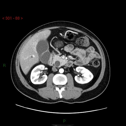 Ampullary carcinoma (Radiopaedia 56396-63056 B 34).jpg