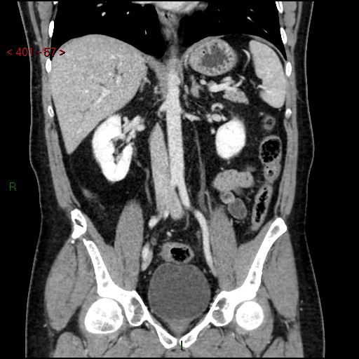 Ampullary carcinoma (Radiopaedia 56396-63056 E 56).jpg
