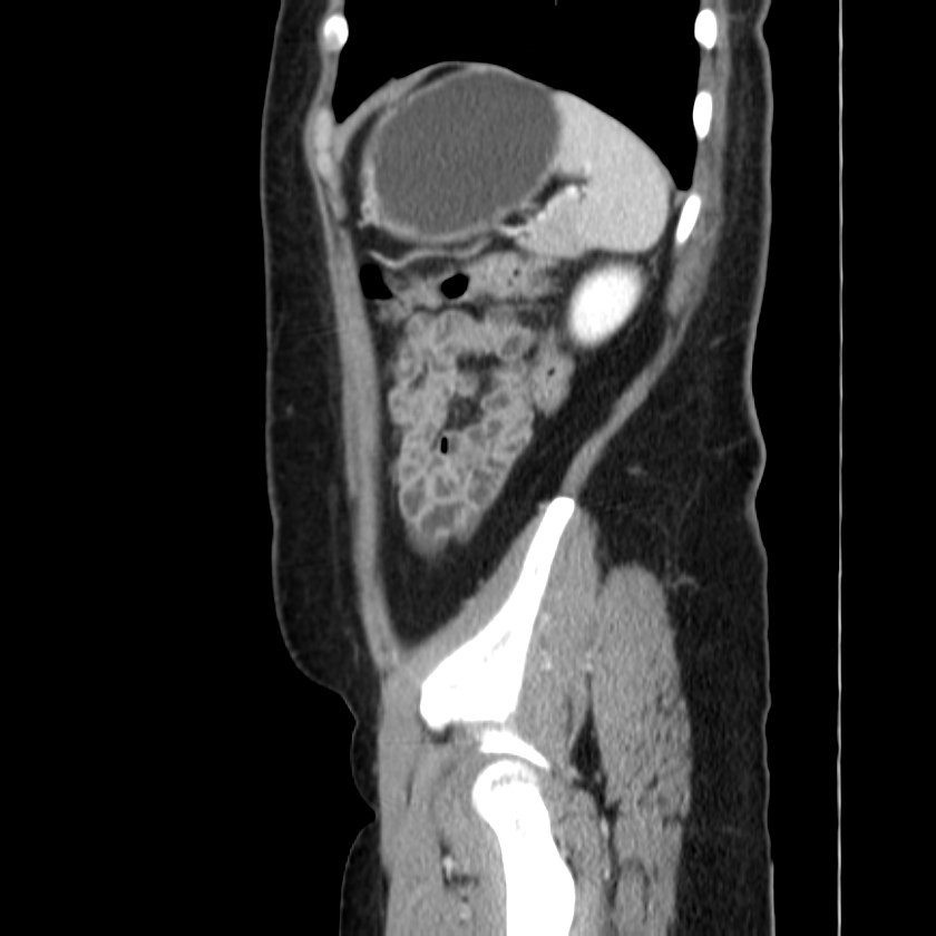 Ampullary tumor (Radiopaedia 22787-22816 D 46).jpg