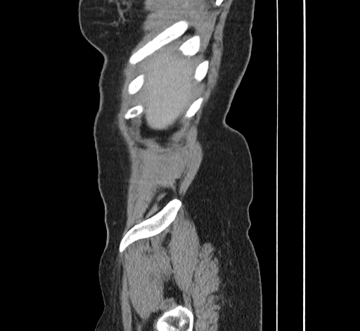 Ampullary tumor (Radiopaedia 60333-67998 C 1).jpg