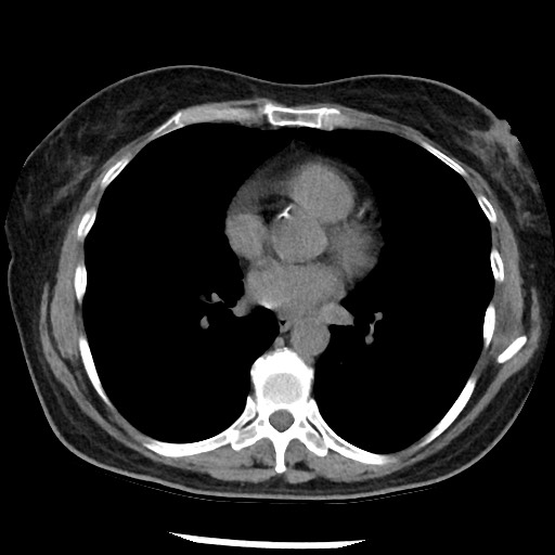 File:Amyloidosis - bronchial and diffuse nodular pulmonary involvement (Radiopaedia 60156-67744 Axial non-contrast 33).jpg