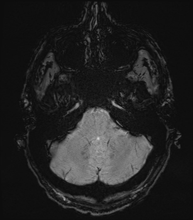 Amyotrophic lateral sclerosis (Radiopaedia 87352-103658 Axial SWI 5).jpg