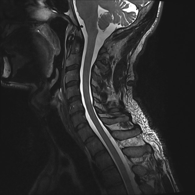 Amyotrophic lateral sclerosis (Radiopaedia 87352-103658 I 29).jpg