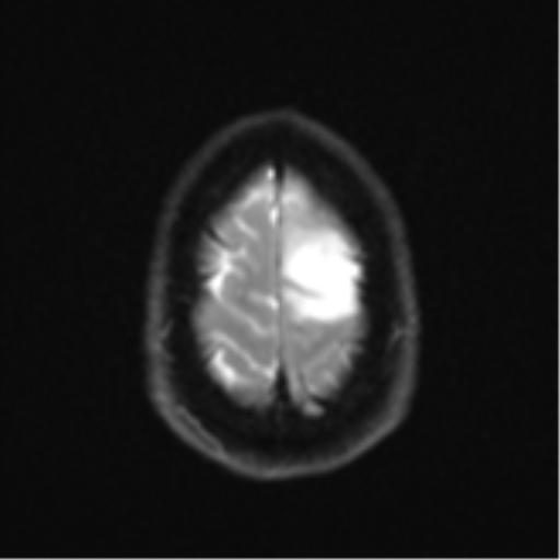 Anaplastic astrocytoma (Radiopaedia 57768-64731 Axial DWI 26).png