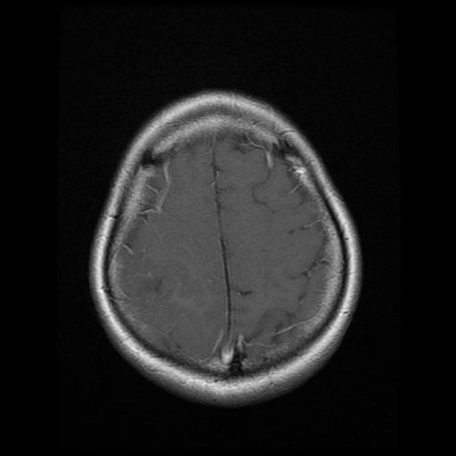 File:Anaplastic astrocytoma (WHO grade III) (Radiopaedia 23559-23664 Axial T1 C+ 18).jpg