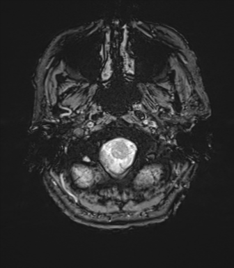 Anaplastic astrocytoma - thalamic glioma (Radiopaedia 59709-67115 G 6).png