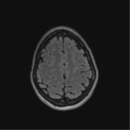 File:Anaplastic astrocytoma IDH mutant (Radiopaedia 50046-55341 Axial FLAIR 40).png