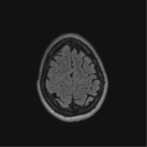 File:Anaplastic astrocytoma IDH mutant (Radiopaedia 50046-55341 Axial FLAIR 42).png