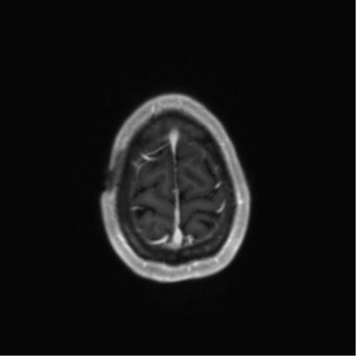File:Anaplastic astrocytoma IDH mutant (Radiopaedia 50046-55341 Axial T1 C+ 45).png