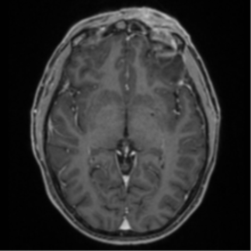 Anaplastic oligodendroglioma with skull fracture (Radiopaedia 74831-85845 Axial T1 C+ fat sat 29).png