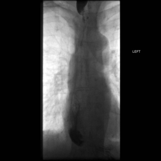 File:Anastomotic stricture post Ivor Lewis esophagectomy (Radiopaedia 47937-52715 B 40).png