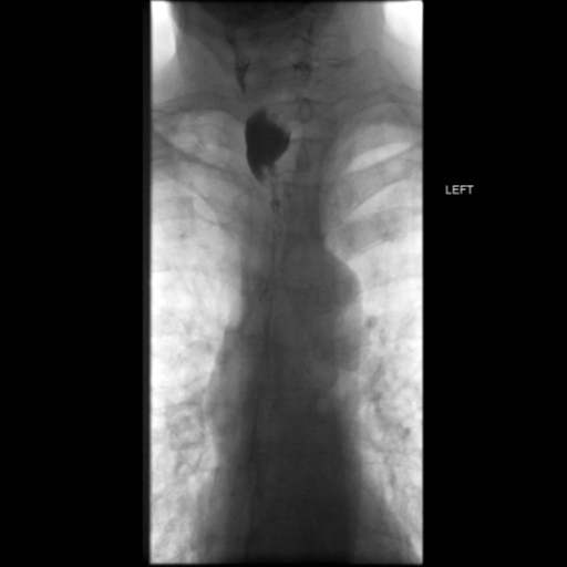 File:Anastomotic stricture post Ivor Lewis esophagectomy (Radiopaedia 47937-52715 Frontal 20).png