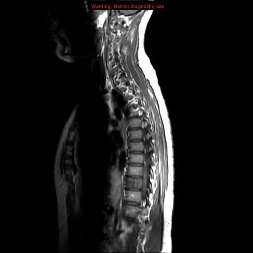 File:Aneurysmal bone cyst (Radiopaedia 9419-10103 Sagittal T1 2).jpg