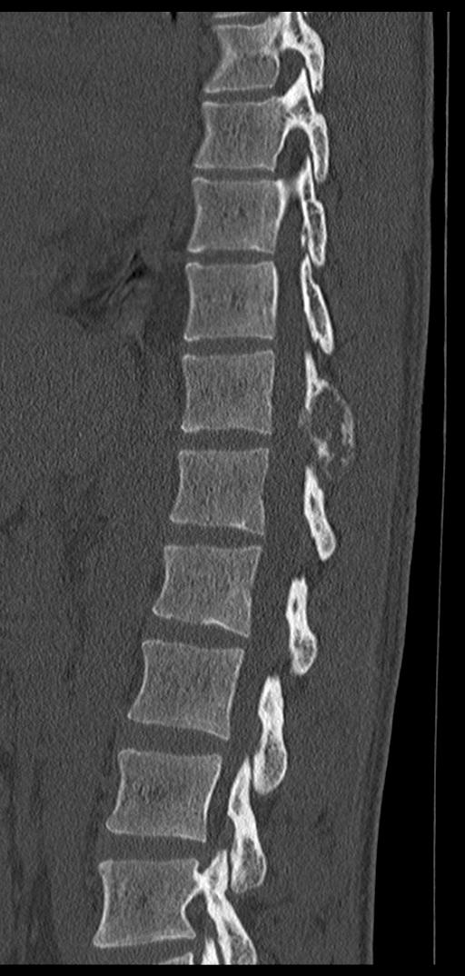 Aneurysmal bone cyst T11 (Radiopaedia 29294-29721 Sagittal bone window 34).jpg