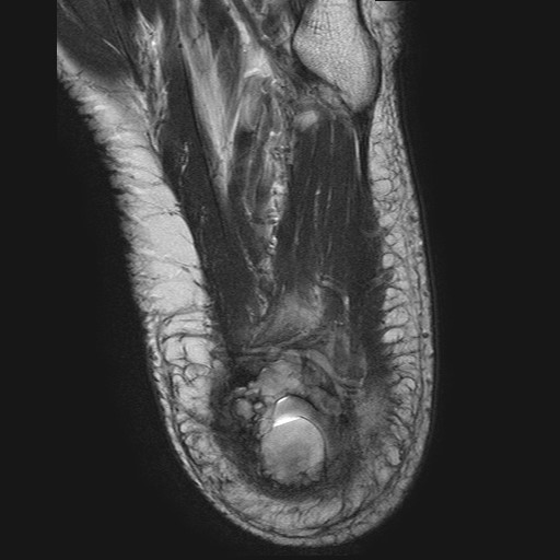 File:Aneurysmal bone cyst of the calcaneus (Radiopaedia 60669-68420 Axial T2 3).jpg