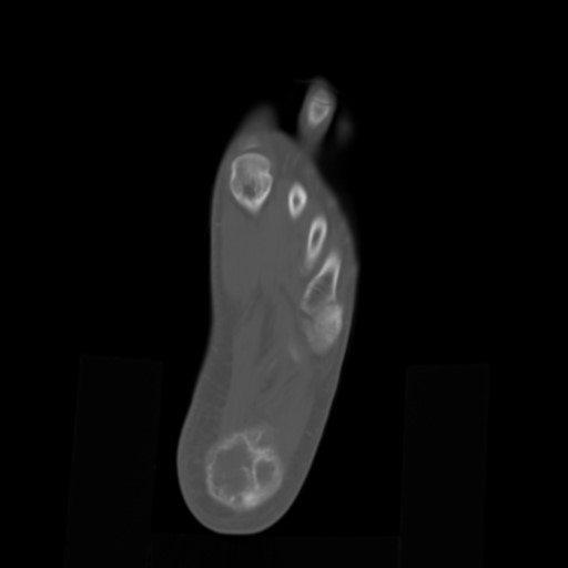 File:Aneurysmal bone cyst of the calcaneus (Radiopaedia 60669-68421 Axial bone window 18).jpg