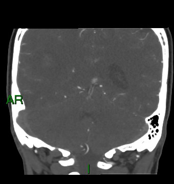 Aneurysmal subarachnoid hemorrhage with intra-axial extension (Radiopaedia 84371-99732 C 35).jpg