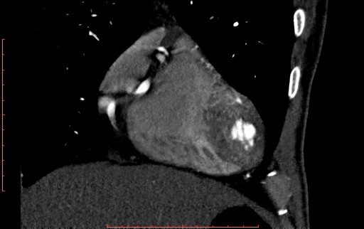 Anomalous left coronary artery from the pulmonary artery (ALCAPA) (Radiopaedia 70148-80181 B 68).jpg