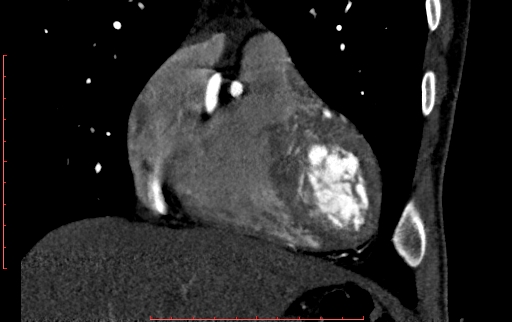 Anomalous left coronary artery from the pulmonary artery (ALCAPA) (Radiopaedia 70148-80181 B 84).jpg