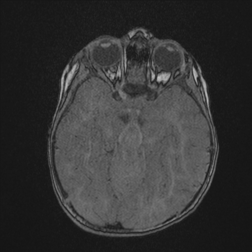 File:Anoxic brain injury (Radiopaedia 79165-92139 Axial MRA 86).jpg