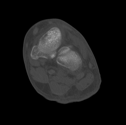 Anterior calcaneal process fracture (Radiopaedia 47384-51989 Coronal bone window 51).png