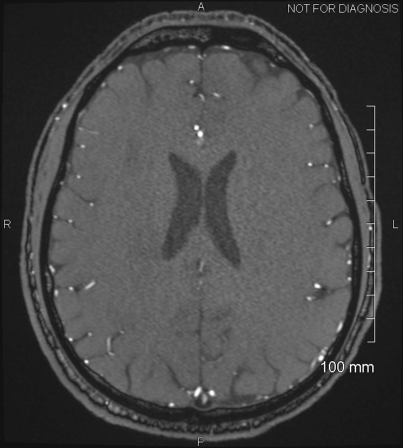 Anterior cerebral artery aneurysm (Radiopaedia 80683-94127 Axial MRA 161).jpg