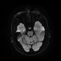 Anterior cerebral artery infarction (Radiopaedia 46794-51323 Axial DWI 10).jpg