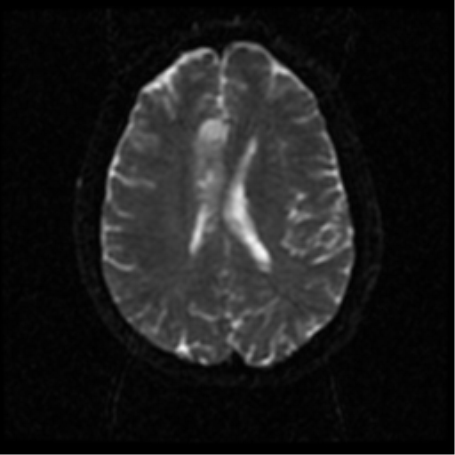 File:Anterior cerebral artery territory infarct (Radiopaedia 39327-41584 Axial DWI 41).png