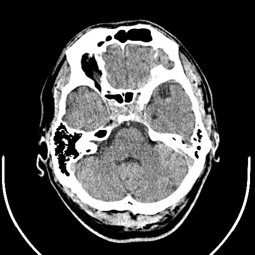 Anterior choroidal artery infarct (Radiopaedia 55106-61480 Axial non-contrast 12).jpg