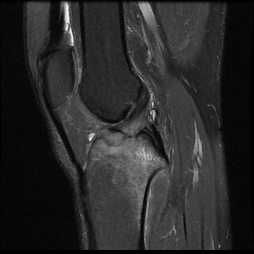 File:Anterior cruciate ligament avulsion fracture (Radiopaedia 58939-66193 Sagittal PD fat sat 11).jpg