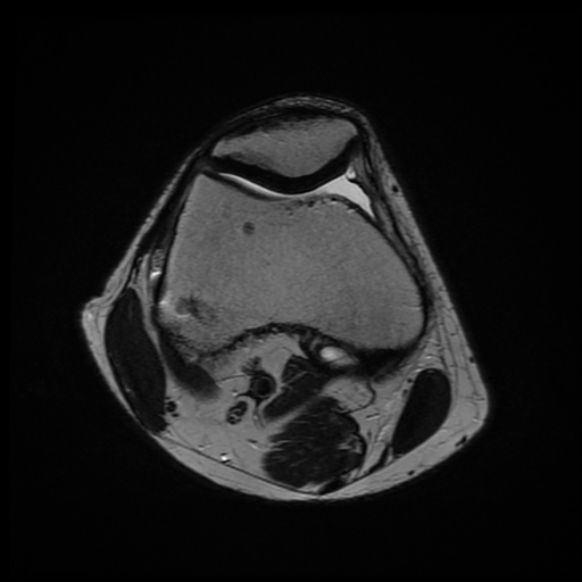 File:Anterior cruciate ligament graft tear and bucket-handle tear of medial meniscus (Radiopaedia 75867-87254 Axial T2 19).jpg