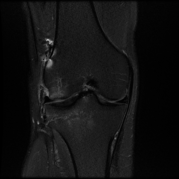 File:Anterior cruciate ligament graft tear and bucket-handle tear of medial meniscus (Radiopaedia 75867-87254 Coronal PD fat sat 13).jpg