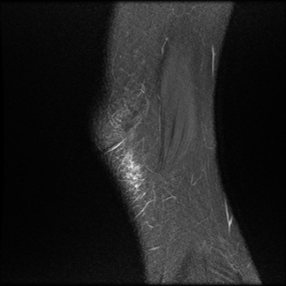 File:Anterior cruciate ligament graft tear and bucket-handle tear of medial meniscus (Radiopaedia 75867-87255 Sagittal PD fat sat 1).jpg