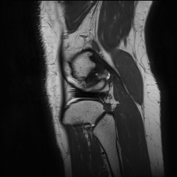 Anterior cruciate ligament rupture and posteromedial corner injury (Radiopaedia 67338-76723 Sagittal PD 142).jpg