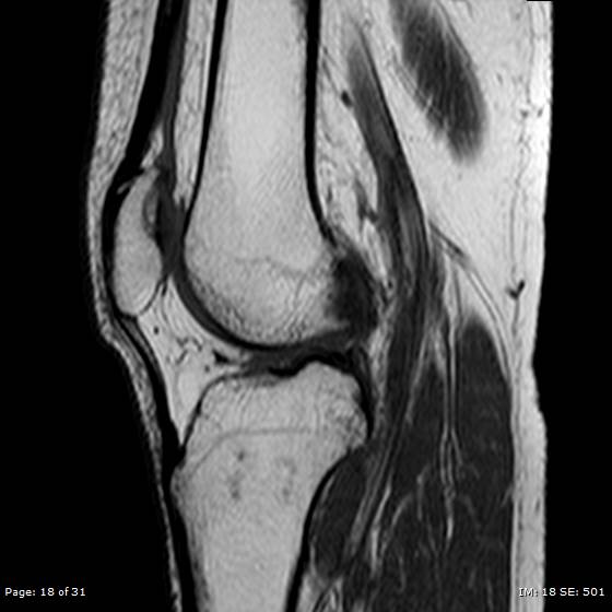 File:Anterior cruciate ligament tear (Radiopaedia 70783-80964 Sagittal T1 18).jpg