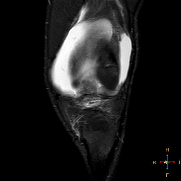 File:Anterior cruciate ligament tear - complete (Radiopaedia 24907-25170 Coronal STIR 5).jpg